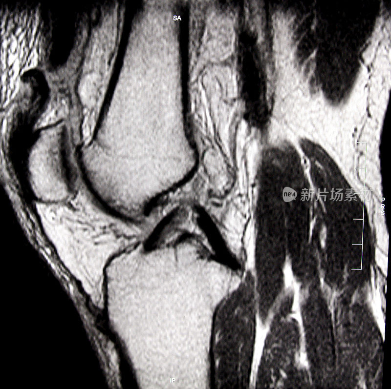 MRI 膝盖
